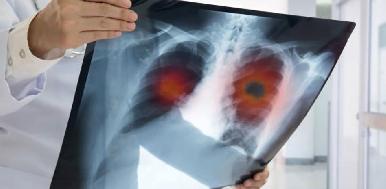 México aprueba aplicación de vacuna contra la tuberculosis