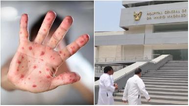 Identifican una nueva cepa de mpox, mejor conocida como ‘viruela del mono’